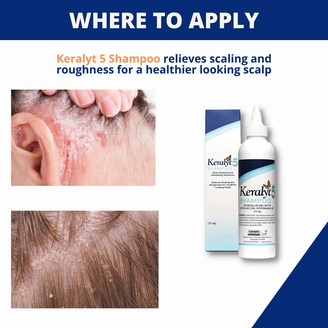 5 Anti-Dandruff Shampoo - Max Strength 5% Salicylic Acid Scalp Build-Up Clearing - Promotes Relief from Dandruff, Psoriasis, Seborrheic Dermatitis, Dryness, and Itchiness, 177 milliliters