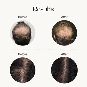 Advanced Hair Growth Serum/For Women & Men/Made With Redensyl, Anagain, Procapil & Rice Water/for Hair Fall/Hair Thinning & for All Hair Types, 50ml