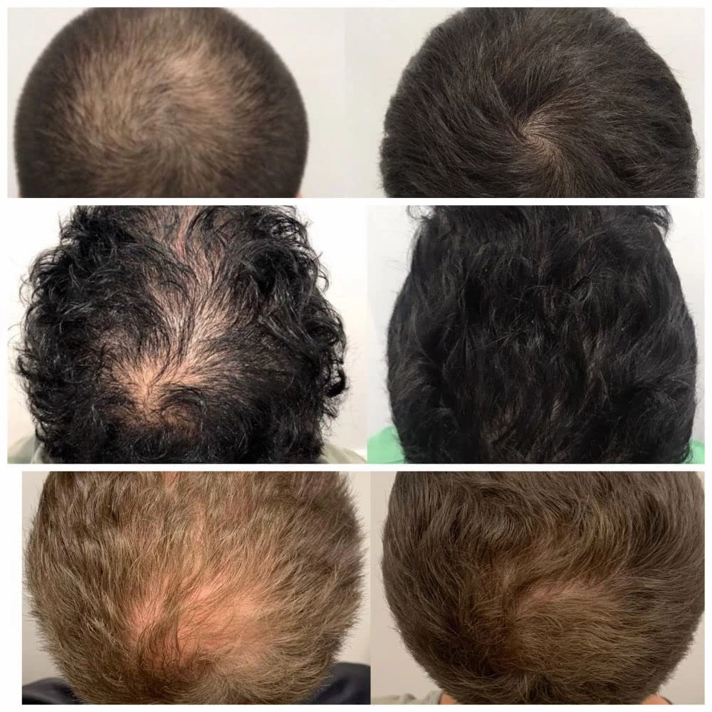 Anti Hair Loss Ginger Shampoo And Conditioner Set|hair loss treatment for men women Hair Grow Fast|Nourish Scalp Hair Anti-Hair Loss |Hair Regrowth | Shampoo And Conditioner Set | 300ml