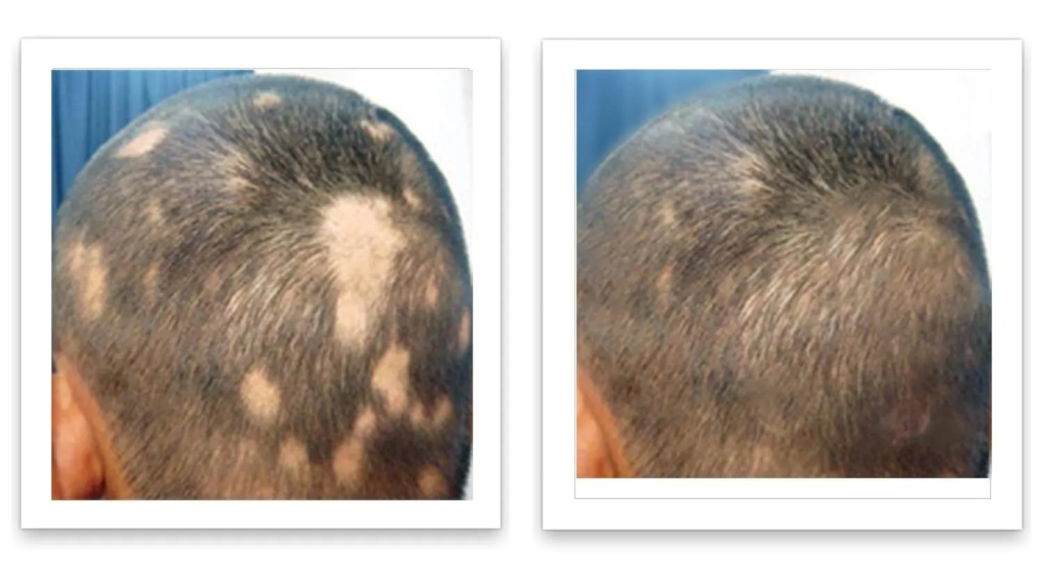 Caboki 10X Volumizing Hair Powder for Thinning Hair: Root Touch Up, Fill in Hairline & Edges, Cover Bald Spots and Gray For Men and Women. TALC-Free,Dark Brown