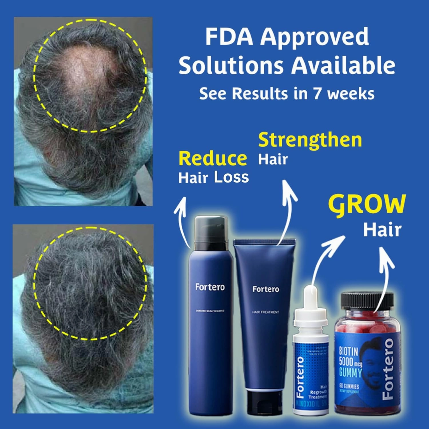 Fortero Hair Regrowth Treatment for Men 5% Minoxidil - Anti-Hair Loss Formula for Pattern Baldness, Alopecia - Anti-Hair Fall, Hair Regrowth, Hair Thinning Treatment 2fl Oz (1 Pack)