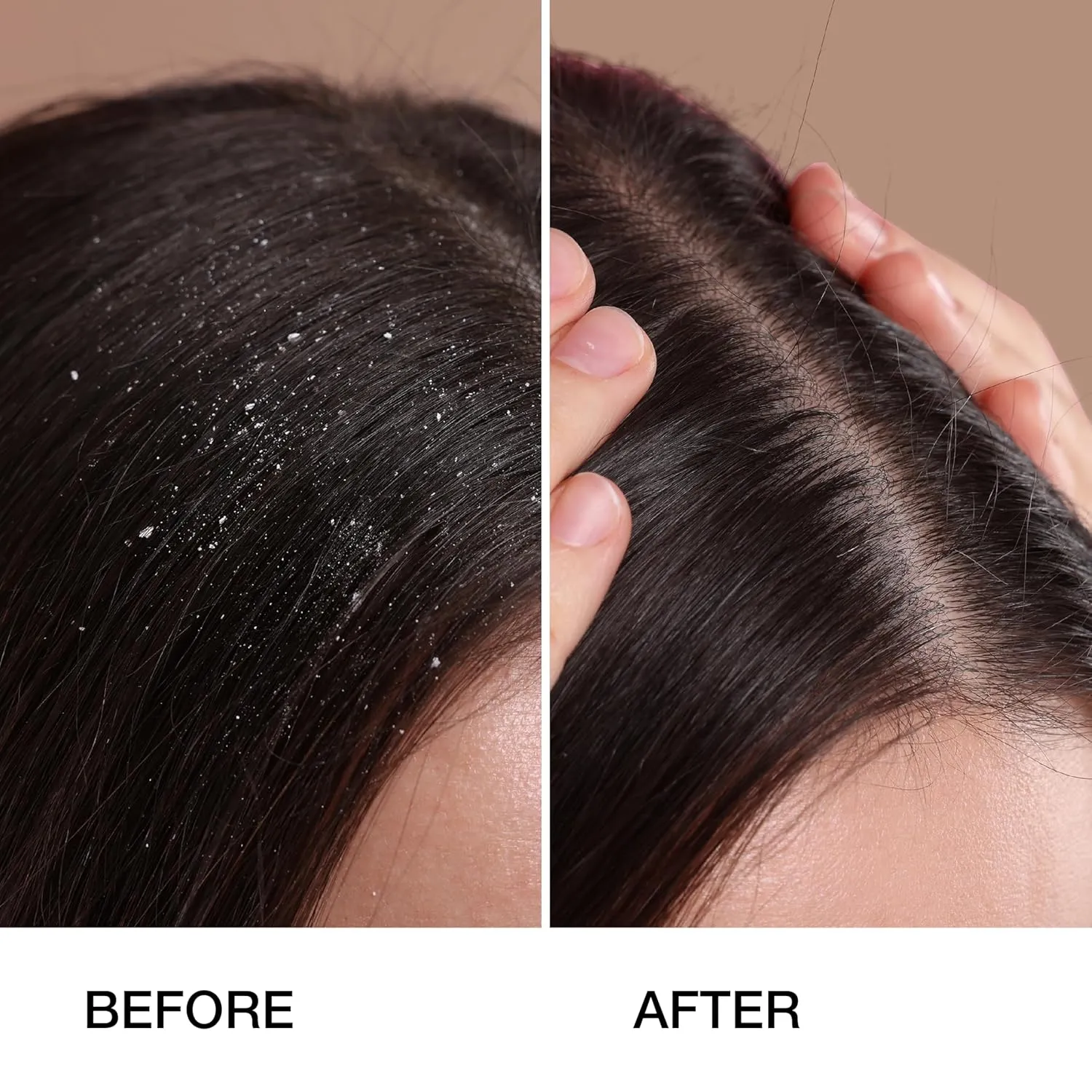 GK HAIR Anti Dandruff Shampoo with 1% Pyrithione Zinc – Flake & Itch Relief, Sulfate-Free Scalp Treatment for Healthy Hair – 8.5 Fl Oz