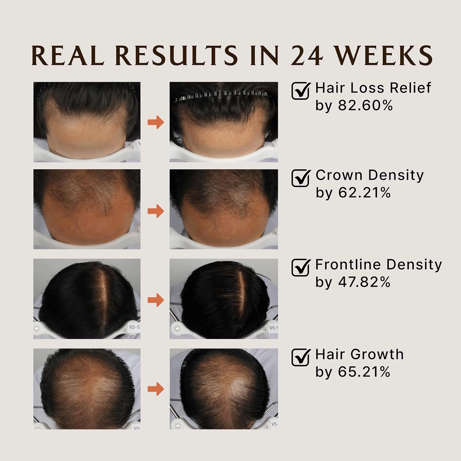 LA'DOR Dermatical Anti Hair Loss & Hair Growth Shampoo - Deep Cleanse, Nourish, Soothe Damaged Scalp w/Salicylic Acid, Dexpanthenol, Niacinamide, Menthol (17.9 Fl Oz, Normal to Dry Hair)