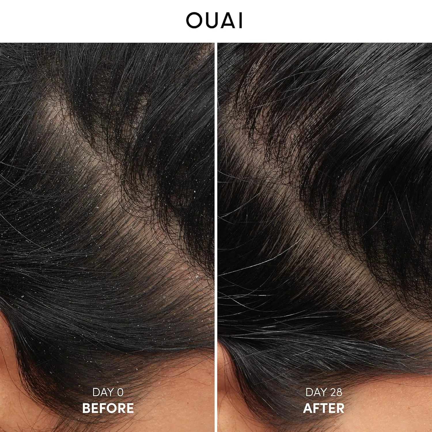 OUAI Anti Dandruff Shampoo - Soothing Salicylic Acid Shampoo for Flaky, Dry and Itchy Scalp - Reduces Itching, Redness and Irritation - Sulfate Free Scalp Care (10 Fl Oz)
