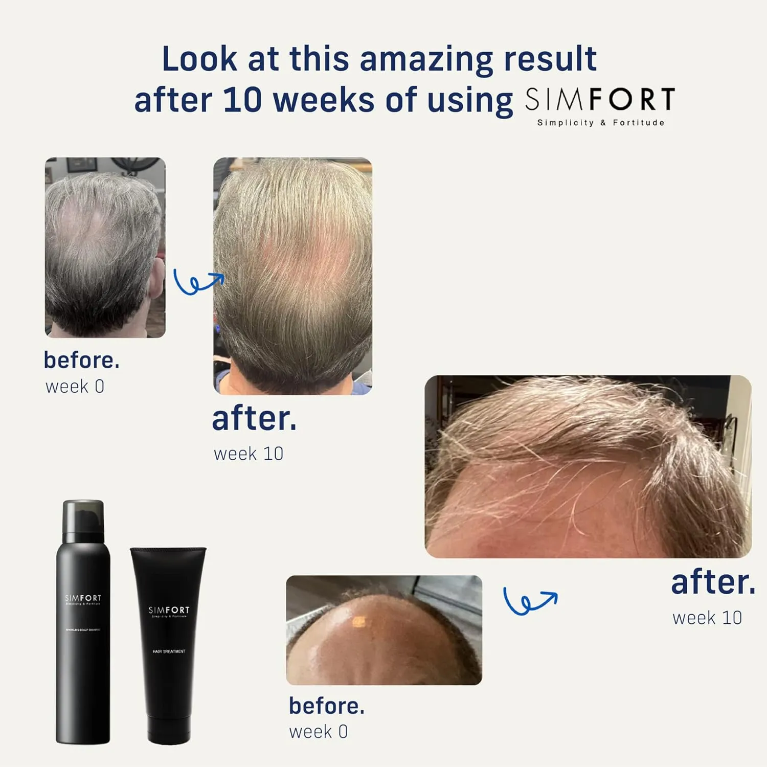 SPARKLING SCALP SHAMPOO Conditioner for Thinning Hair and Hair Loss - Hair Growth Treatment (Hair Growth Kit)
